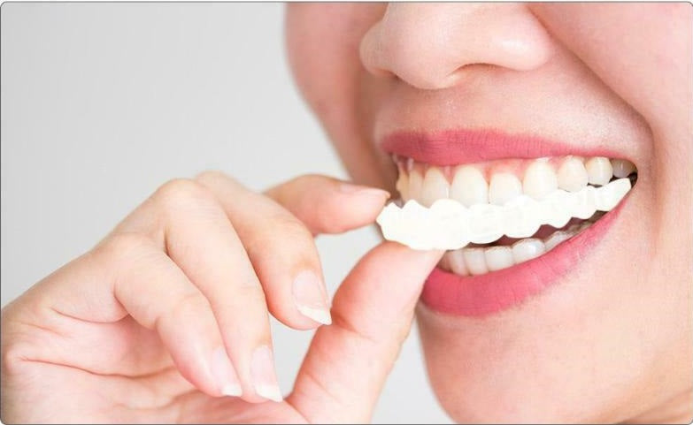 Magic Teeth Brace Perfect Smile Veneers